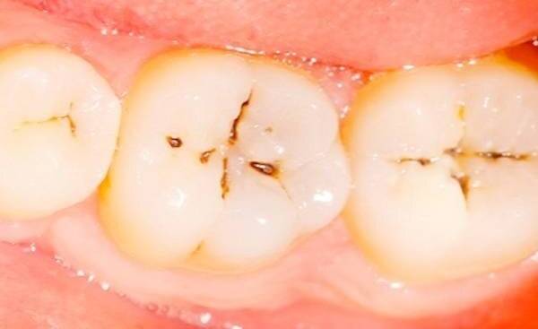 روش های درمان پوسیدگی دندان