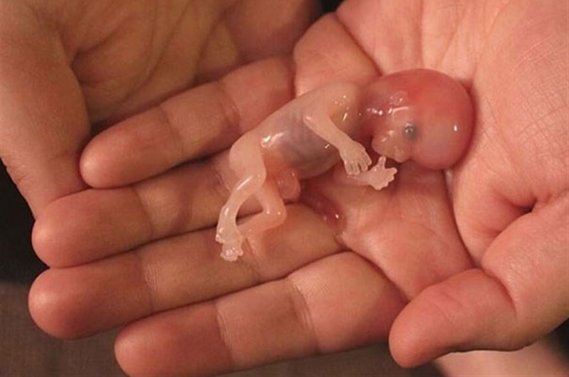 مراقبت هاي بعد از سقط جنين