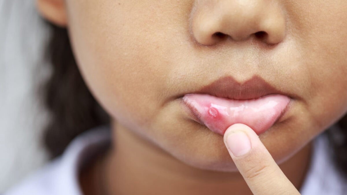 درمان آفت دهان