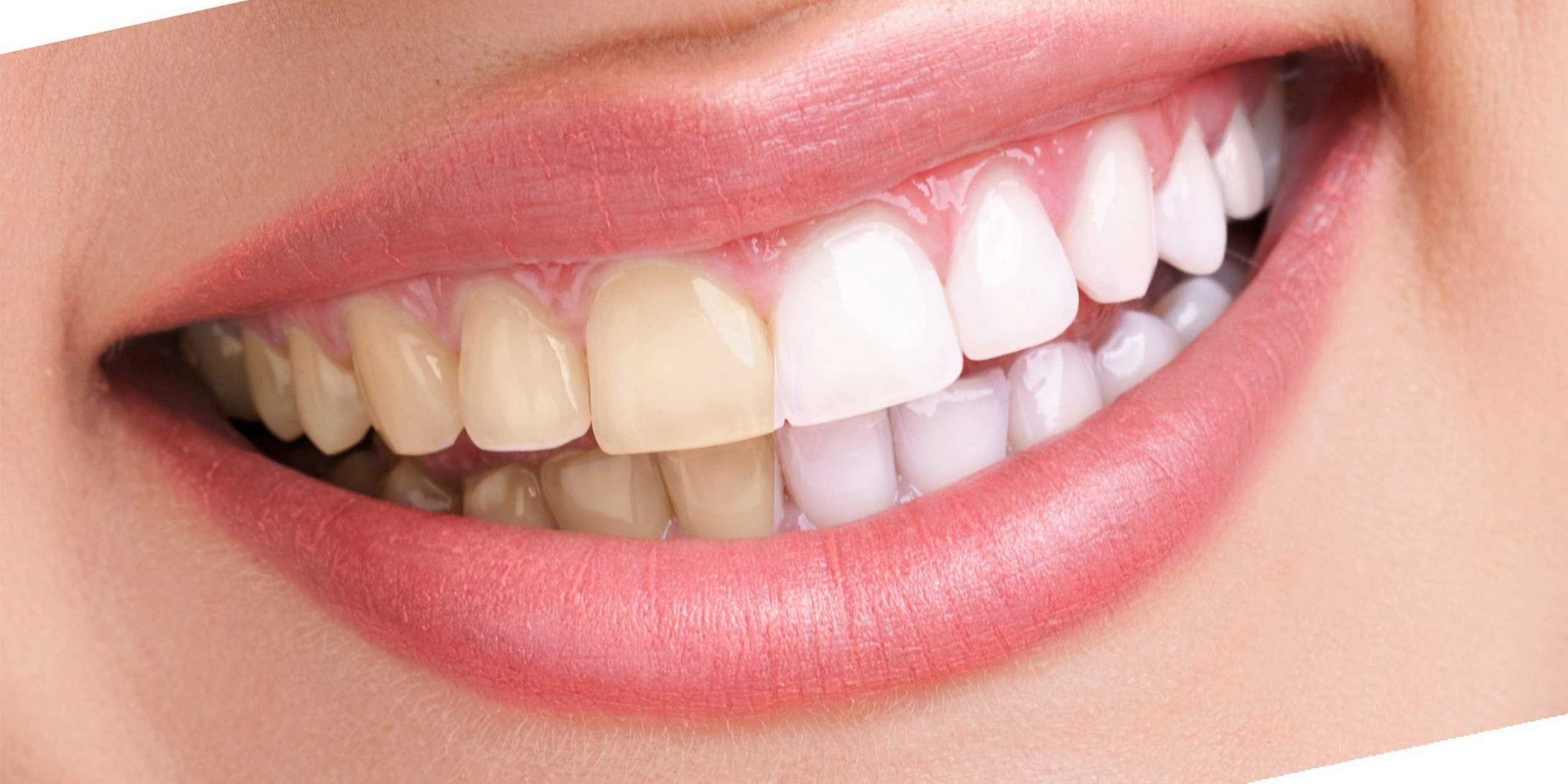 دندان زرد - سفيد كردن دندان با جوش شيرين