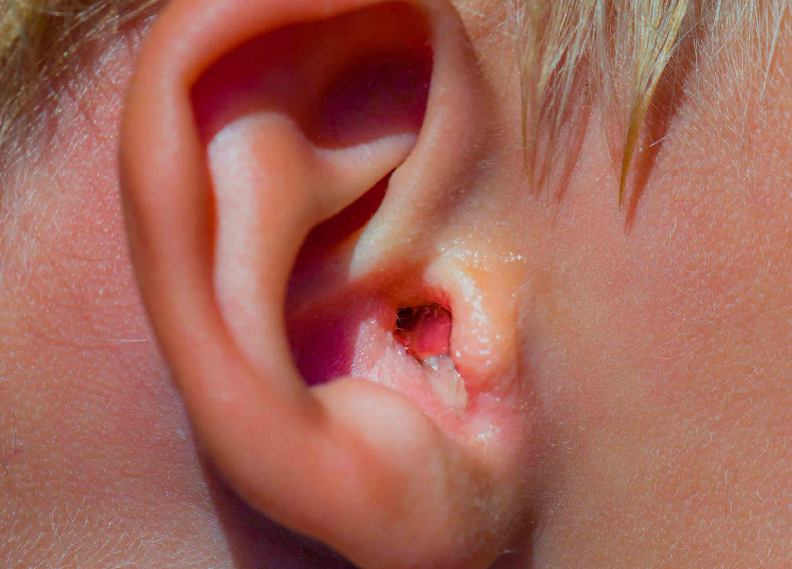 درمان خانگی عفونت گوش - عفونت گوش