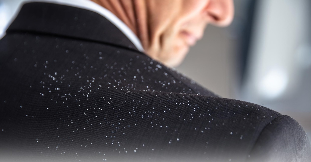 از بین بردن شوره سر