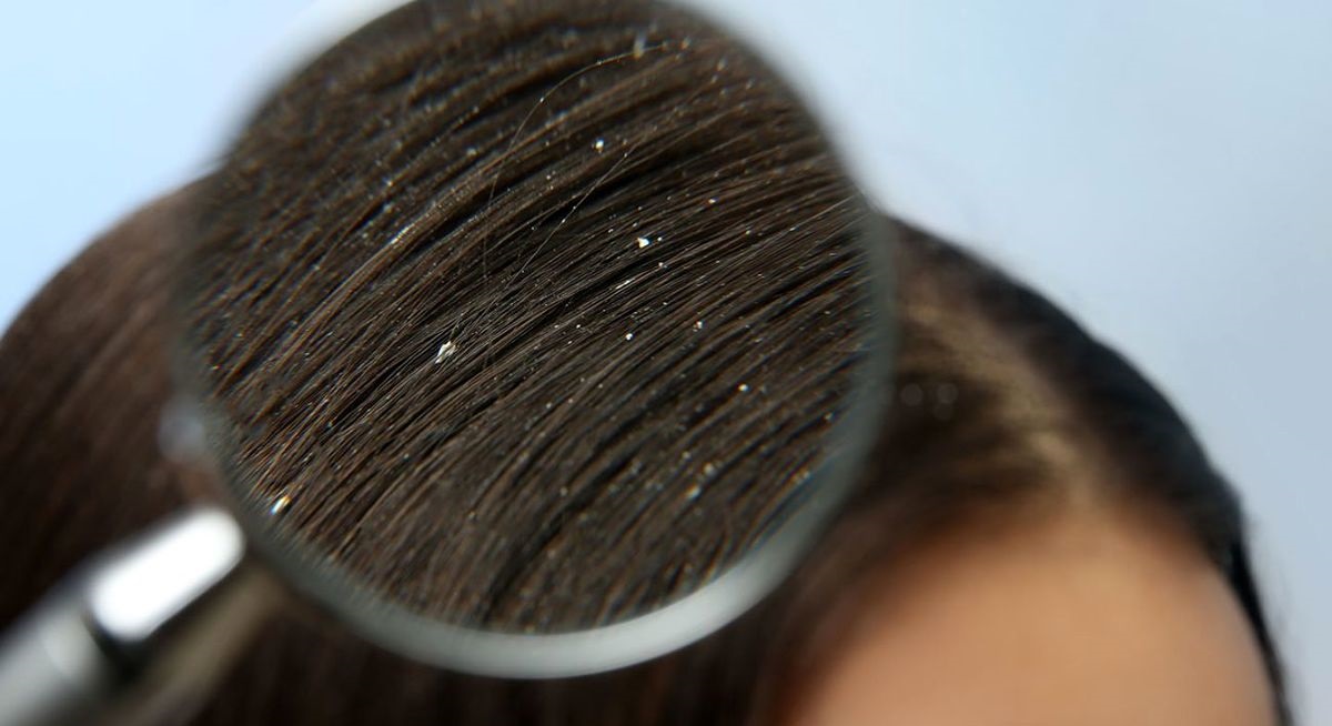 شوره ی سر ریز - از بین بردن شوره سر