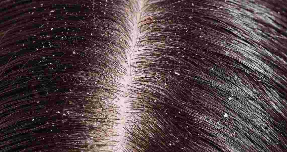 درمان شوره سر - از بین بردن شوره سر