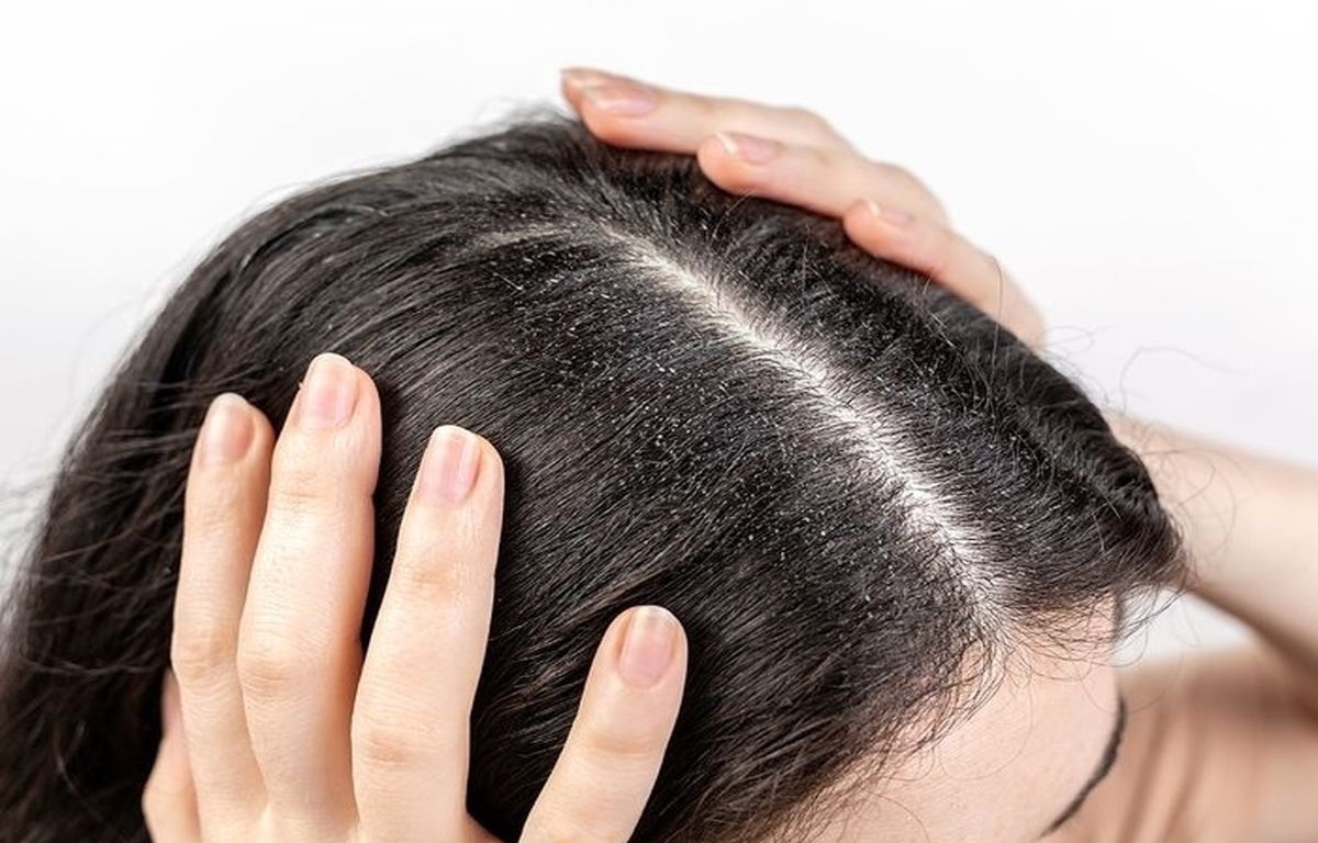 شوره ی سر چرب - از بین بردن شوره سر