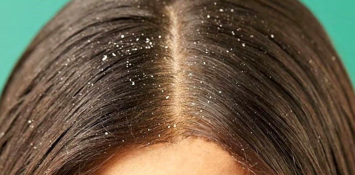 شوره ی خشک سر - از بین بردن شوره سر