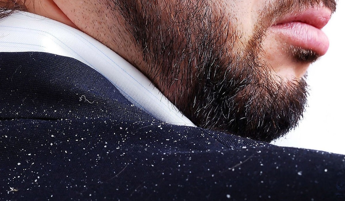 شوره سر آقایان - از بین بردن شوره سر