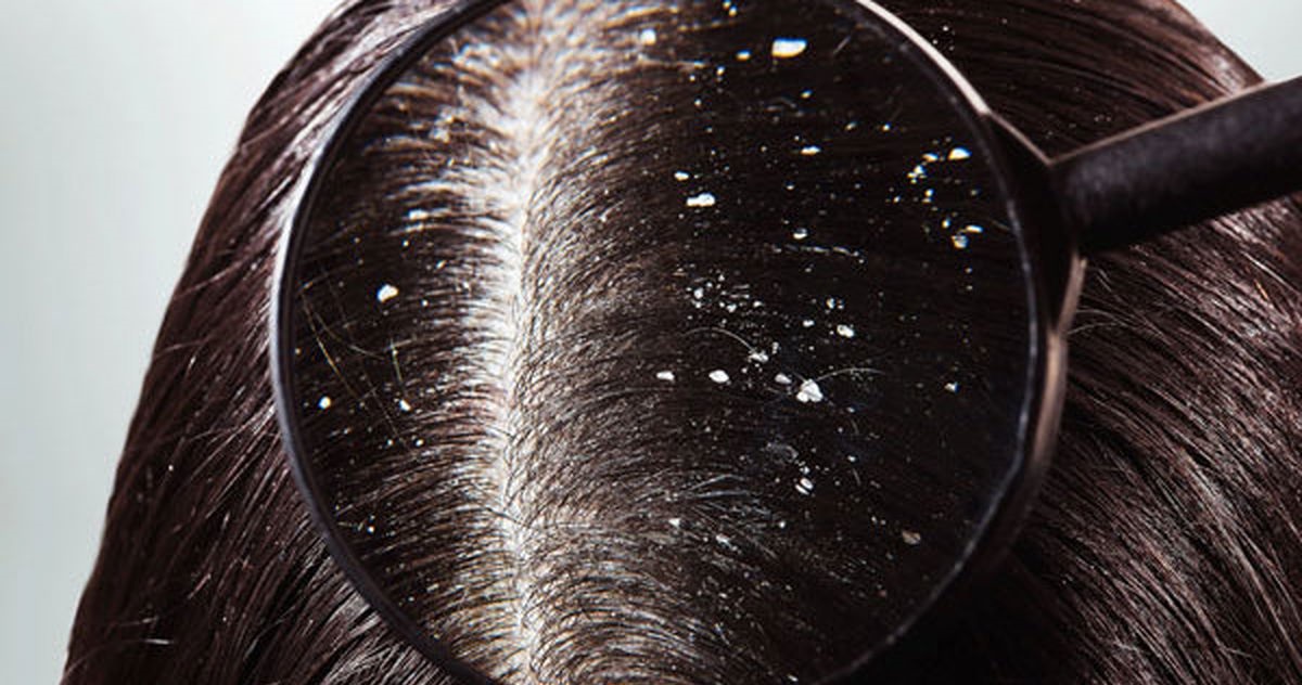 شوره ی سر خانم ها - از بین بردن شوره سر