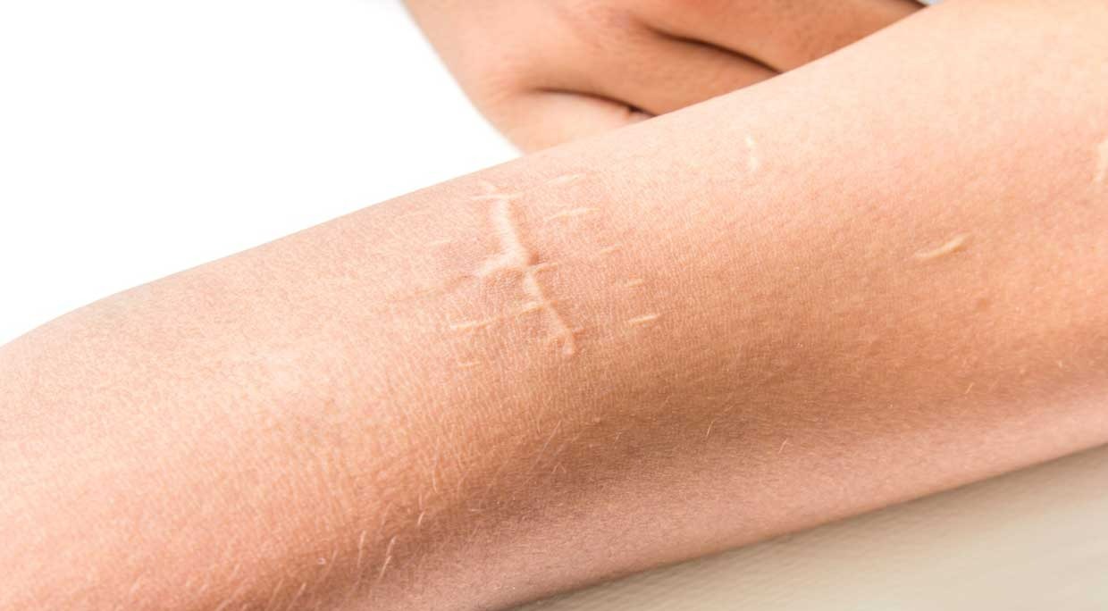 ترمیم جای زخم