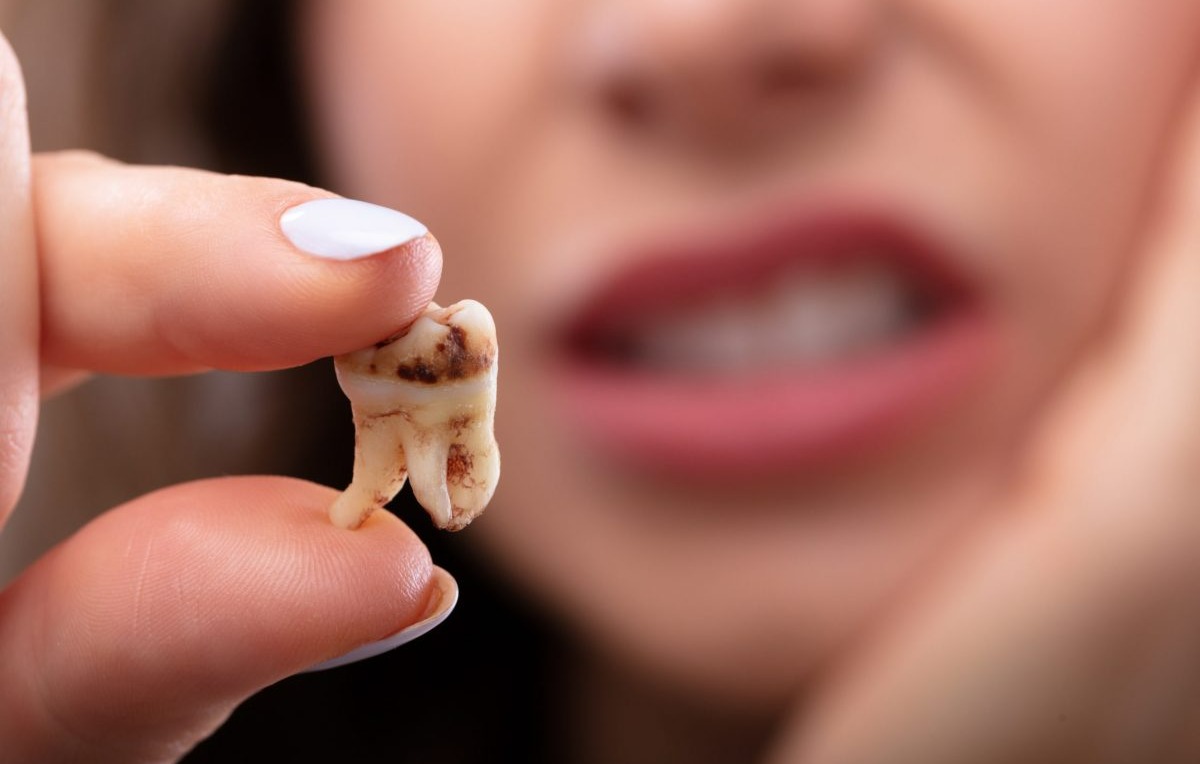 دندان کشیده شده زن - جراحی دندان عقل