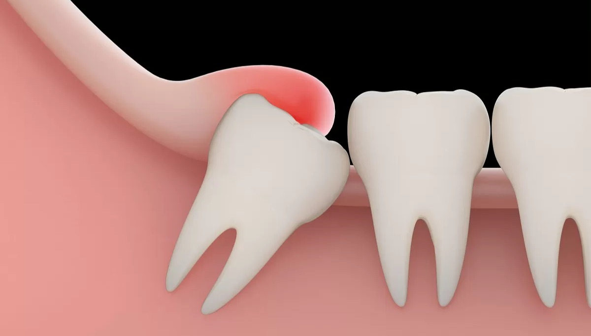 موقعیت دندان عقل - جراحی دندان عقل