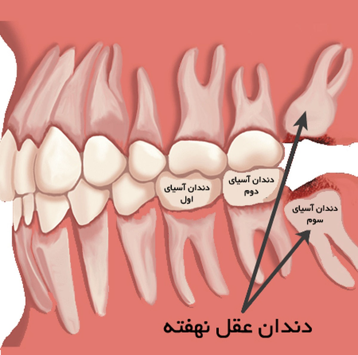 جای دقیق دندان عکس در تصویر - جراحی دندان عقل