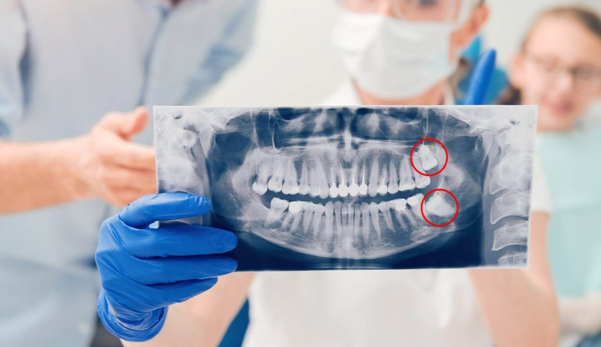عکس رادیولوژی دندان در دست دکتر - جراحی دندان عقل