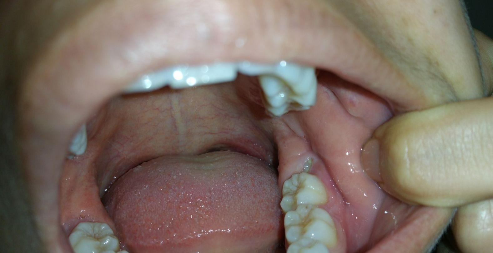 دندان عقل - جراحی دندان عقل