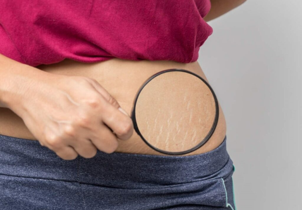 رفع ترک پوستی