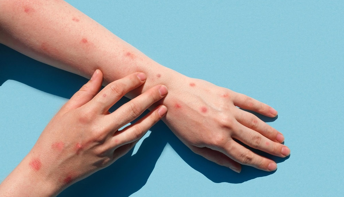 درمان خانگی آبله مرغان