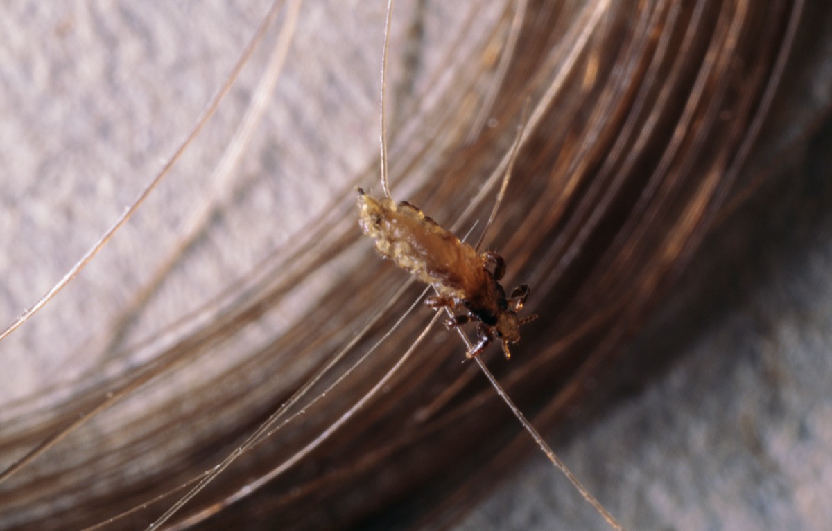 درمان فوری شپش