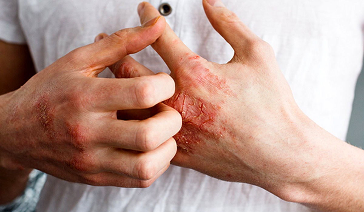 حساسیت به مواد شوینده