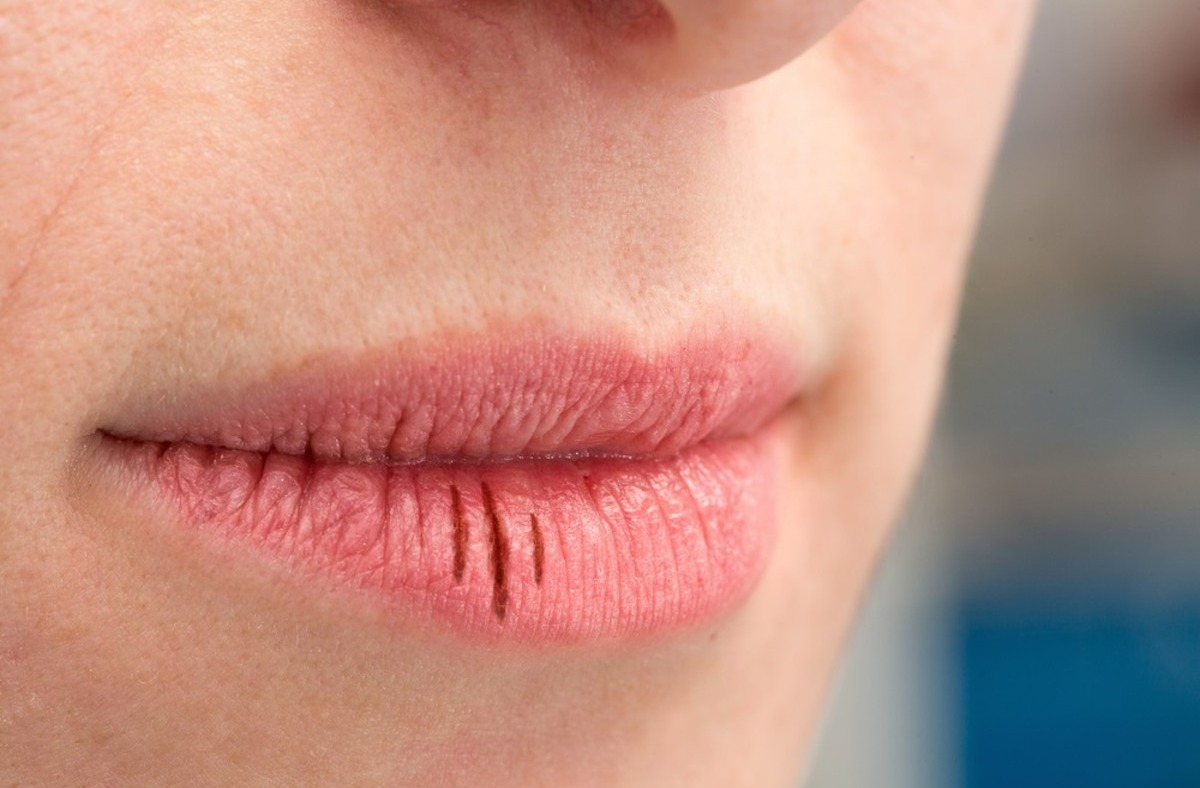 پوسته شدن لب - علت خشکی دهان