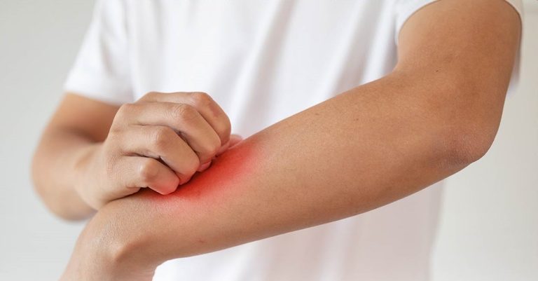 درمان-اگزما