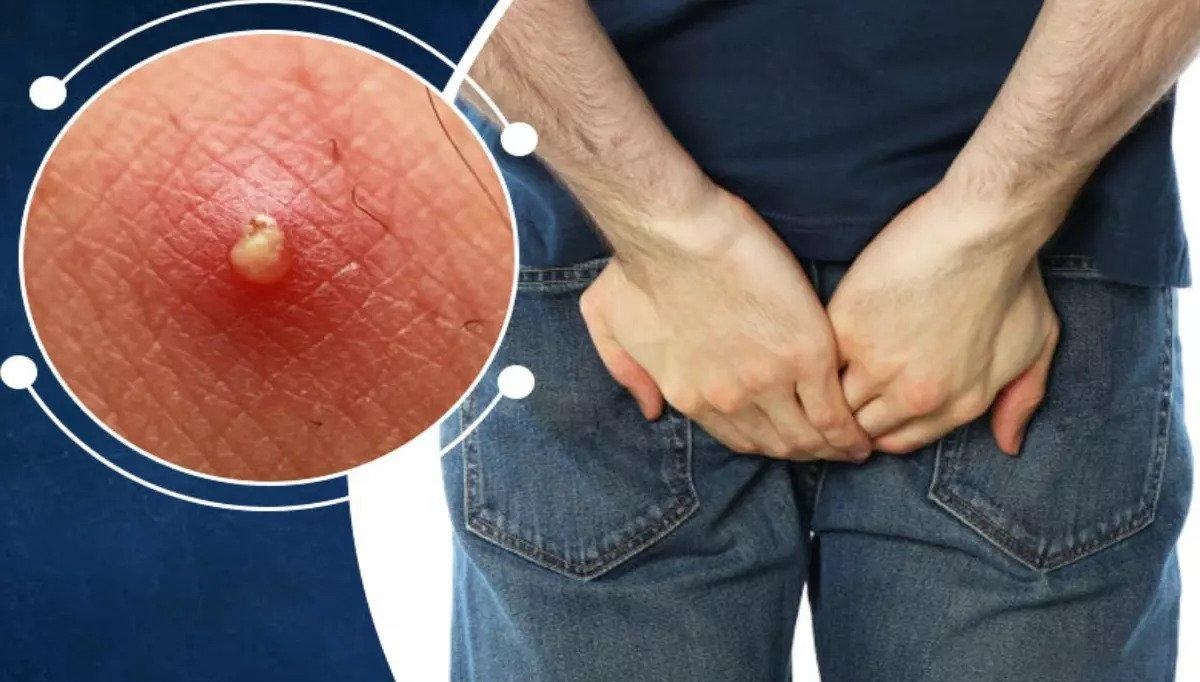 درمان جوش باسن