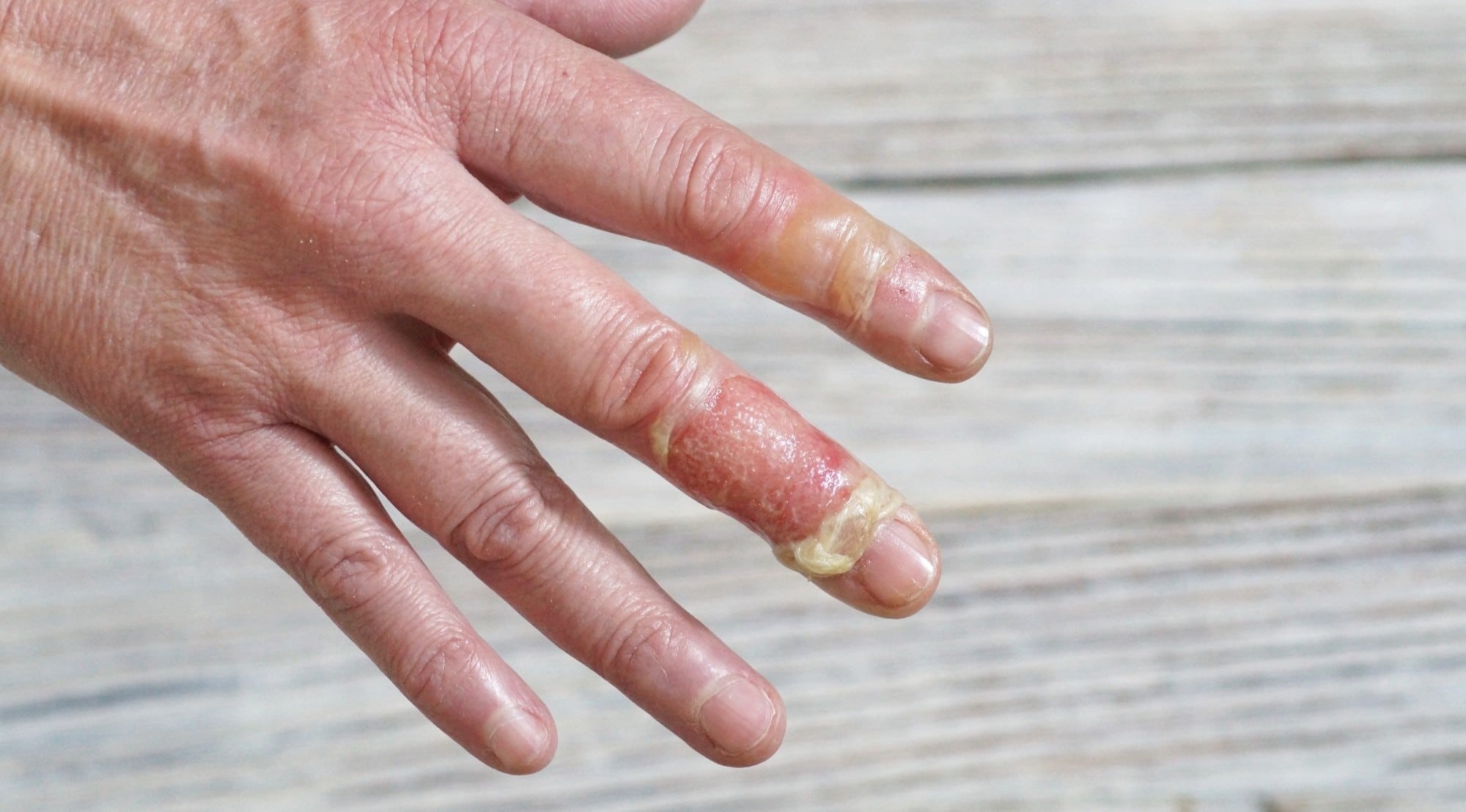 دست سوخته شده با روغن - درمان سوختگی با روغن