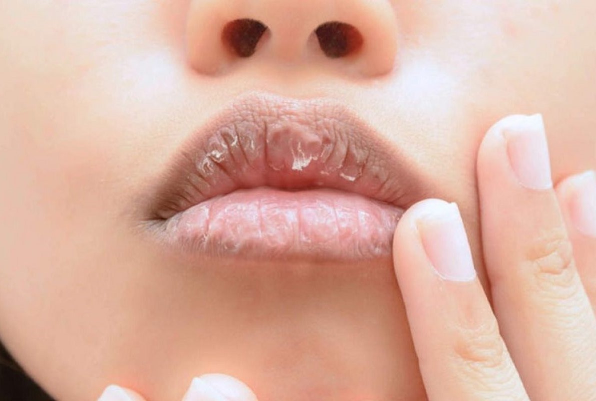 درمان خشکی لب در ماه رمضان