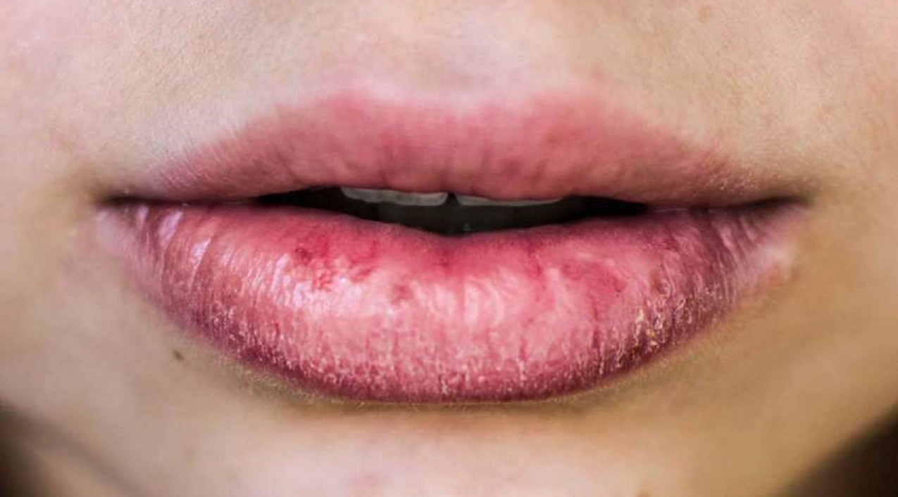 درمان خشکی لب - خشکی لب در ماه رمضان