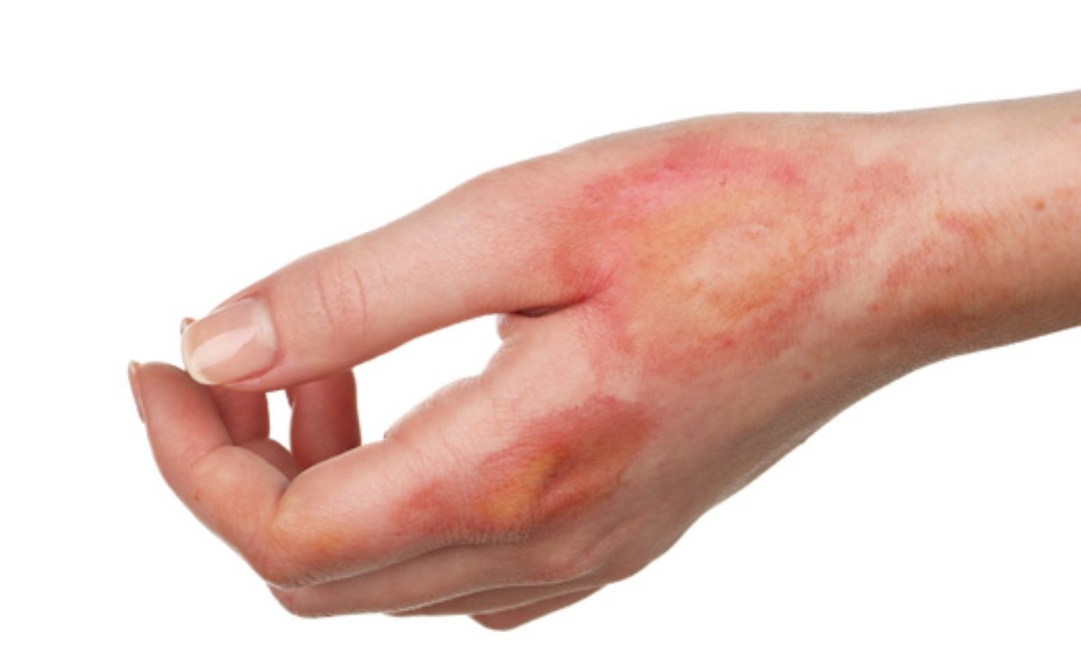 سوختگی دست - درمان سوختگی با روغن