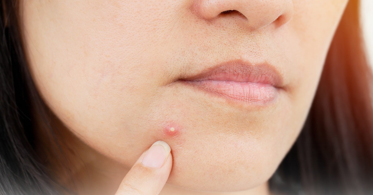 از بین بردن جوش سر سفید