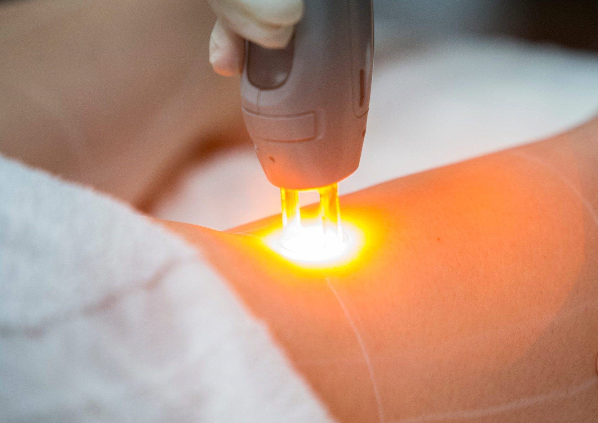 انتقال زگیل تناسلی با لیزر