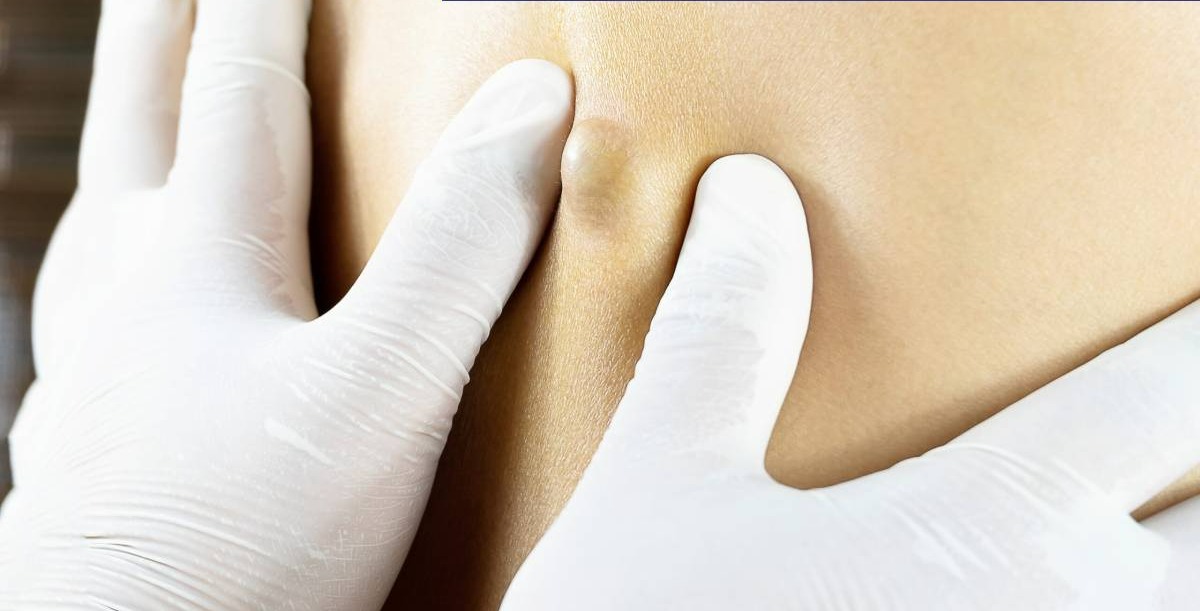 درمان خانگی کیست مویی