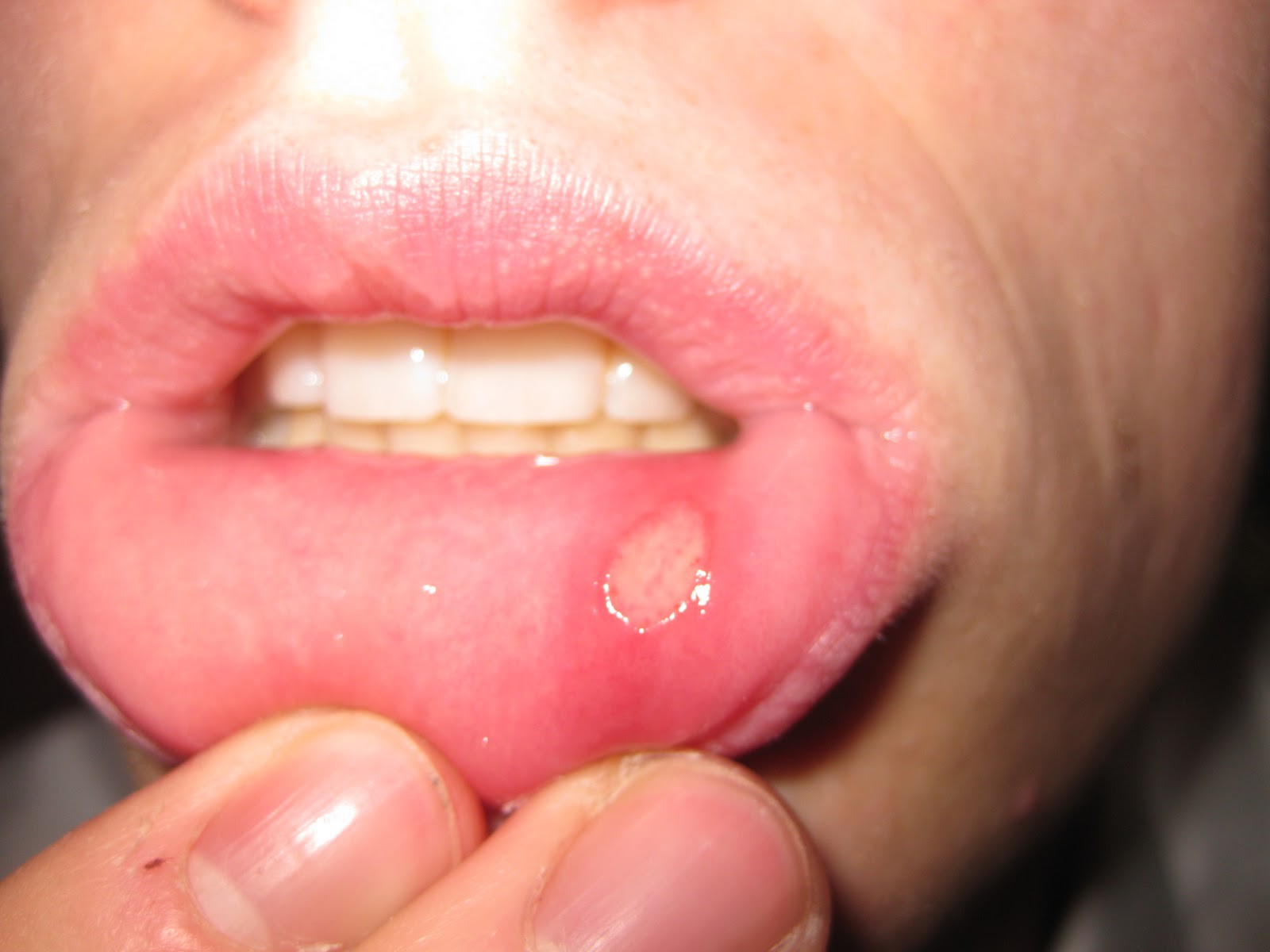 آفت دهان - درمان آفت دهان با رب انار