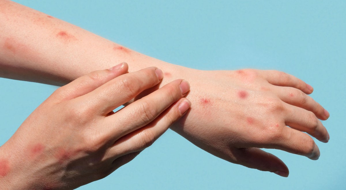 آبله میمونی