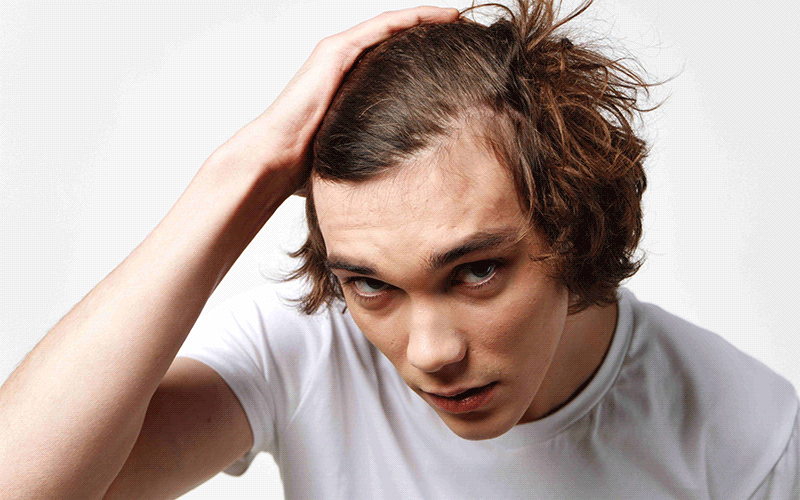 درمان ریزش مو در جوانان