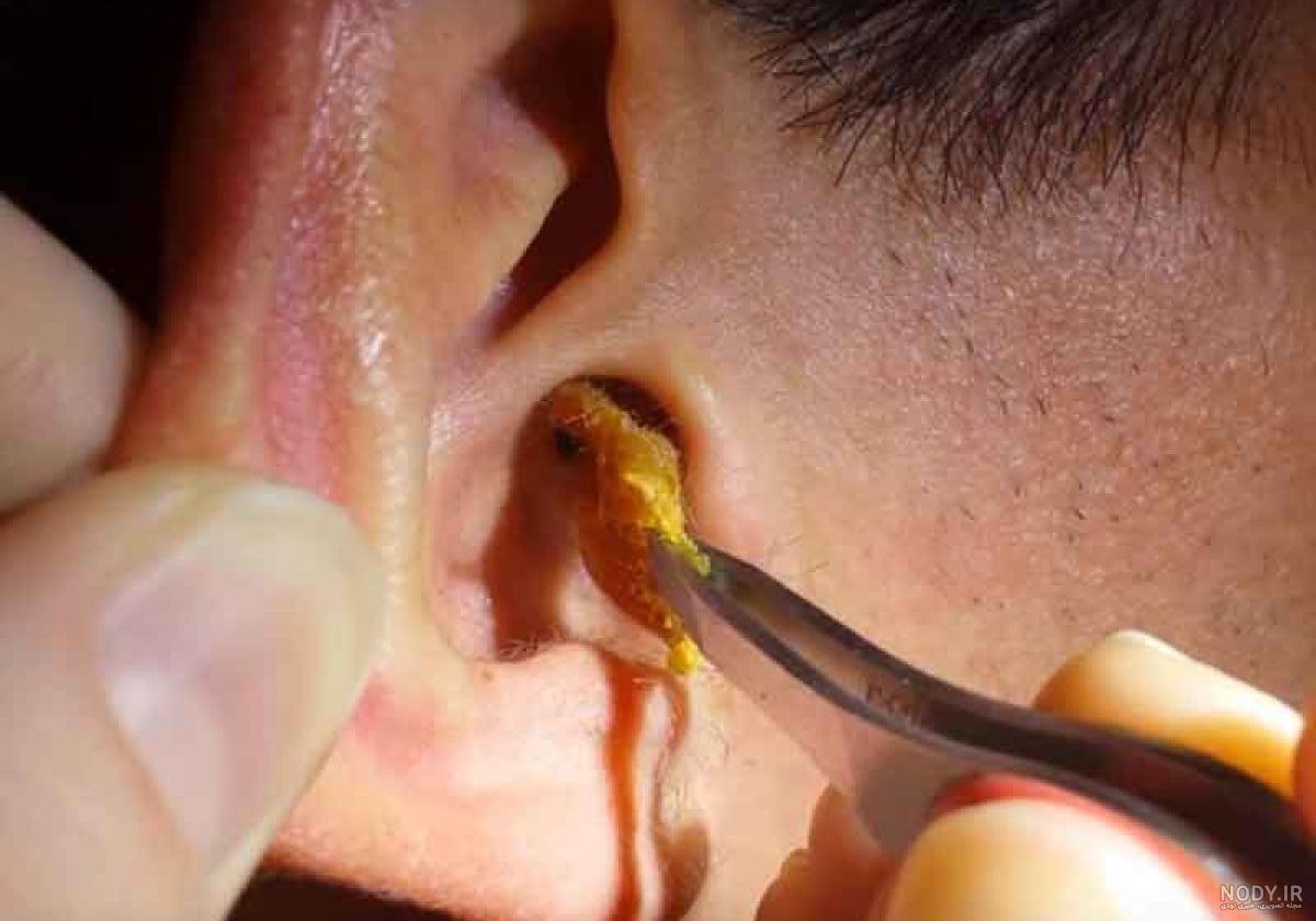 تخلیه جرم گوش با کاغذ