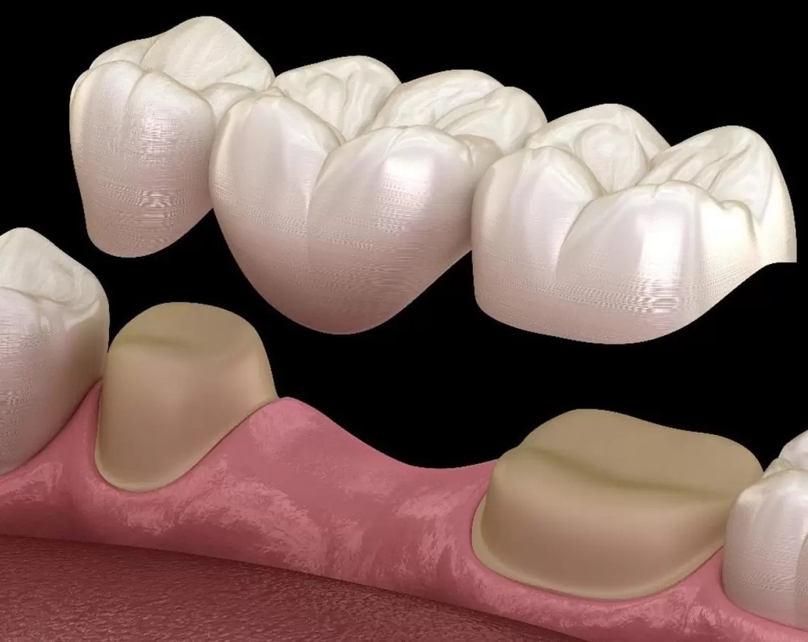 از بین بردن بوی بد روکش دندان - چگونه چسب روکش دندان را از بین ببریم