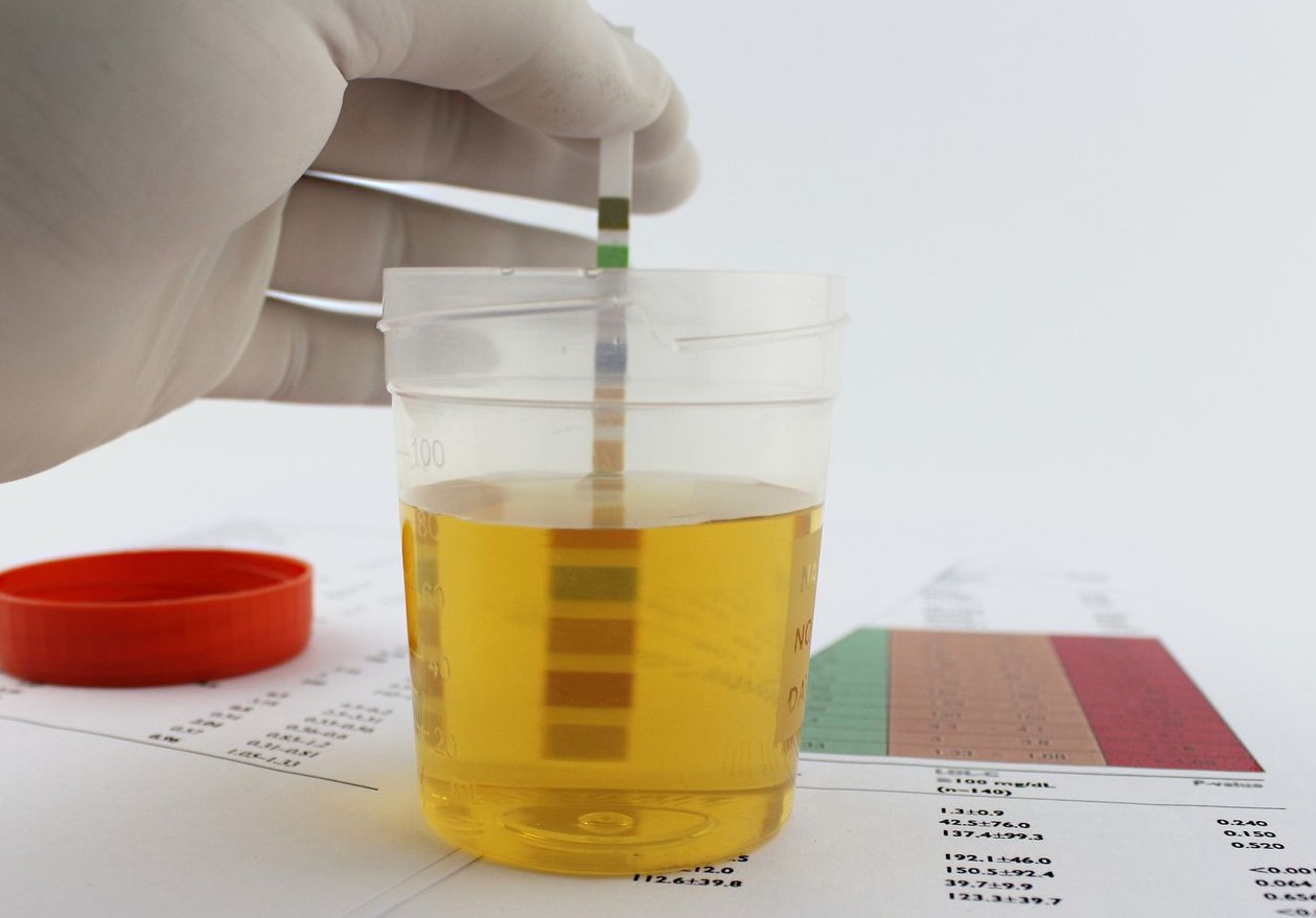 دفع پروتئین در بارداری - علائم دفع پروتئین در بارداری