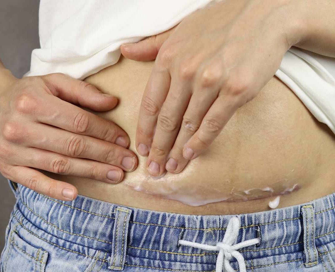 مراقبت های بعد از سزارین