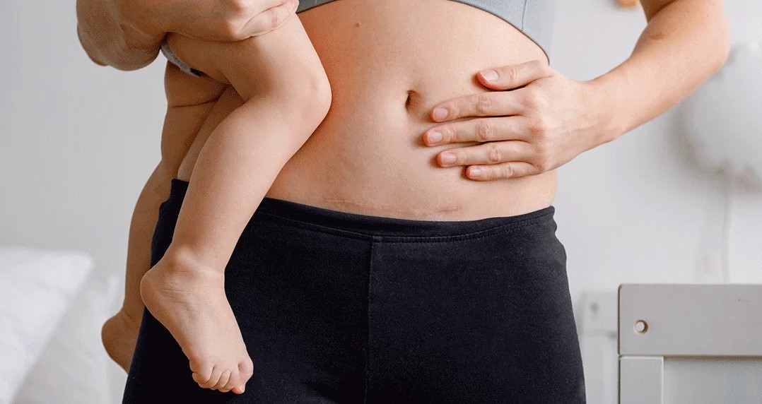 سزارین - مراقبت های بعد از سزارین