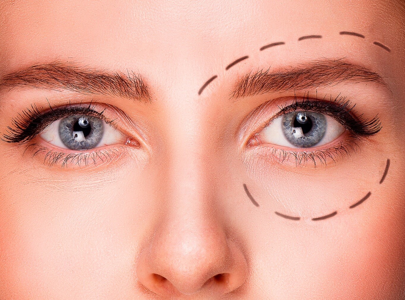 افتادگی پلک - رفع افتادگی پلک در خانه