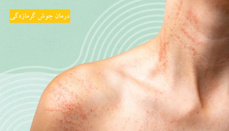 درمان جوش گرمازدگی